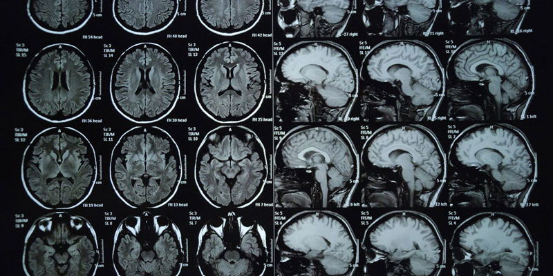 Hình ảnh minh họa chụp MRI sọ não của bệnh nhân.