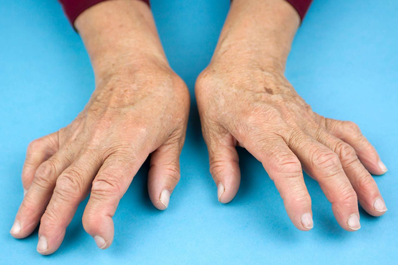 Bàn tay của bệnh nhân dần trở nên biến dạng 