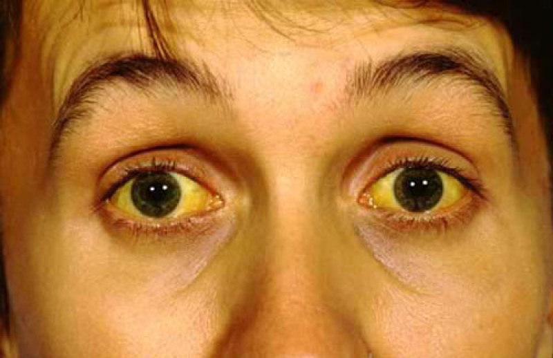 Vàng da, vàng mắt là triệu chứng dễ dàng nhận biết nhất