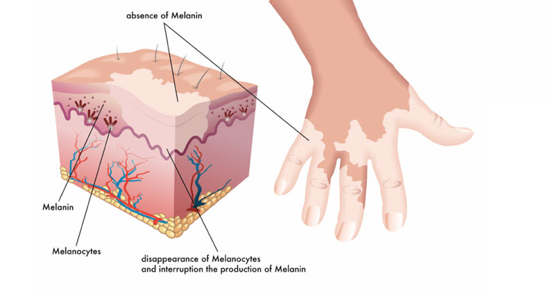 Bạch biến là bệnh da liễu liên quan đến những tế bào sắc tố da bị hủy hoại