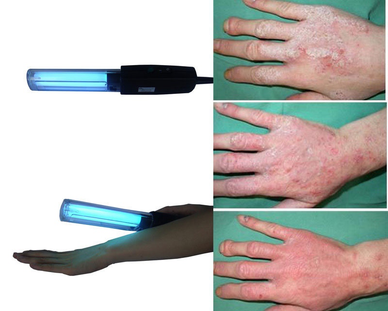 Dùng đèn chiếu tia UV lên da để kết luận bạn có mắc bệnh hay không