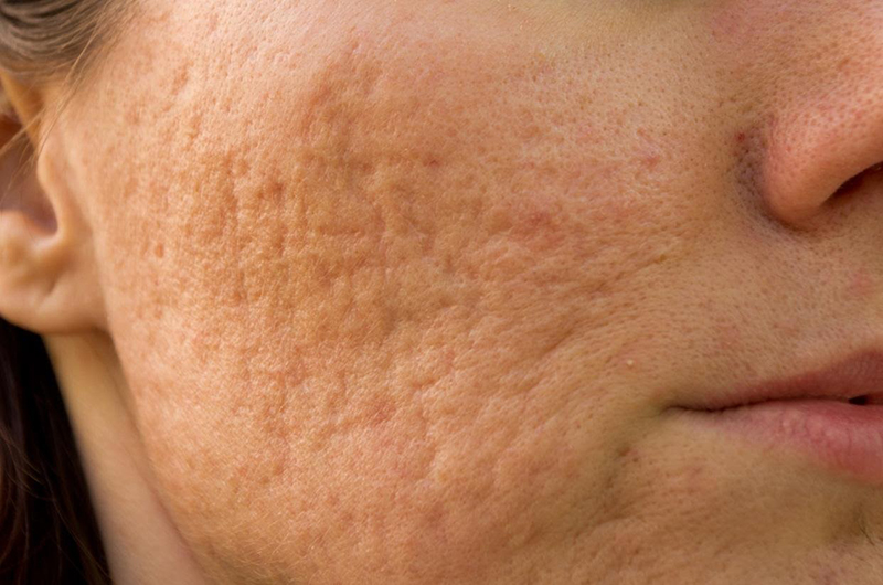 Việc điều trị không đúng cách có thể khiến vùng da nổi mụn để lại sẹo gây mất thẩm mỹ