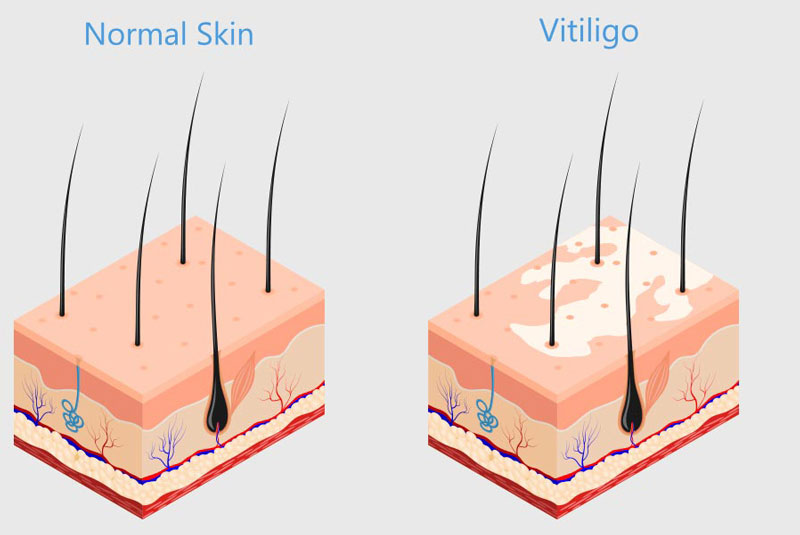 Số lượng và chất lượng tế bào sắc tố da bị suy giảm là nguồn cơn gây bệnh