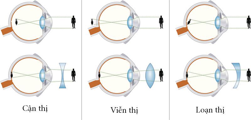 Hình ảnh các vật thể được phản chiếu ở mắt của những người mắc các tật khúc xạ