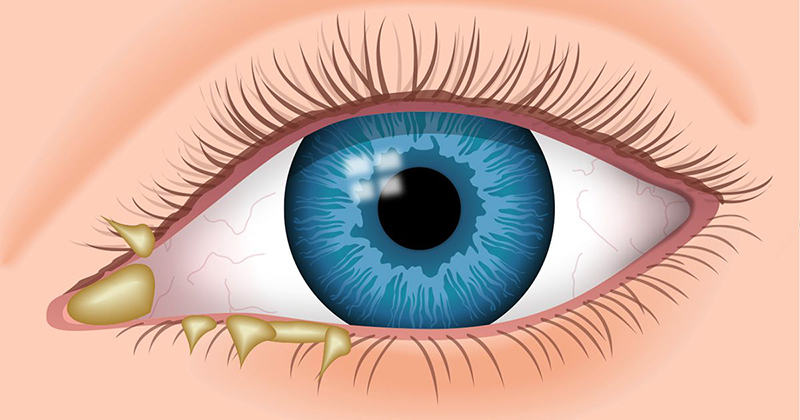 Bệnh nhân bị đau mắt đỏ do vi khuẩn có ghèn màu vàng hoặc xanh nhạt