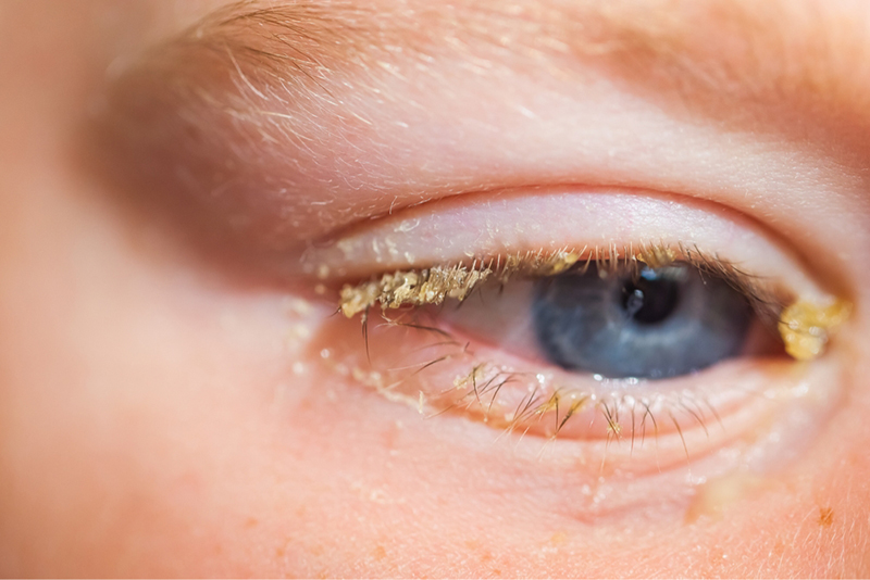 Viêm kết mạc do vi khuẩn khiến 2 mí mắt đóng ghèn vàng 