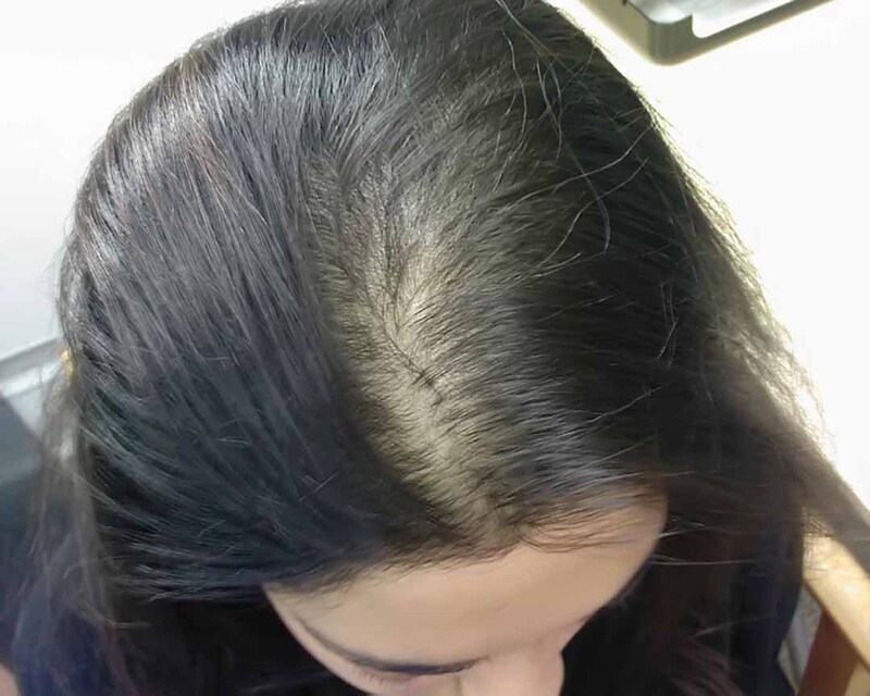 Nấm da đầu gây rụng tóc nhiều