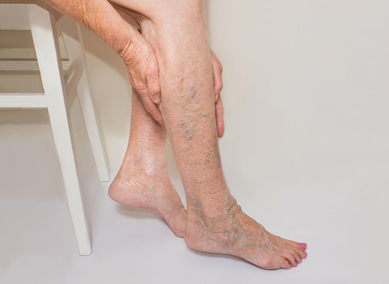 Các đường van tĩnh mạch xanh tím góp phần làm da chân trông già hơn