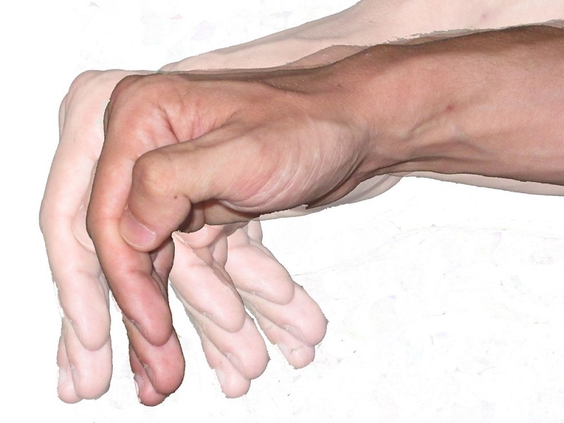 Người bị bệnh Parkinson thường run tay và vận động kém