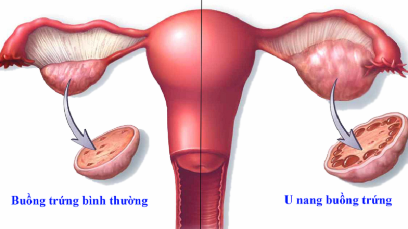 Rối loạn nội tiết tố là một trong những nguyên nhân chính gây ra u nang buồng trứng