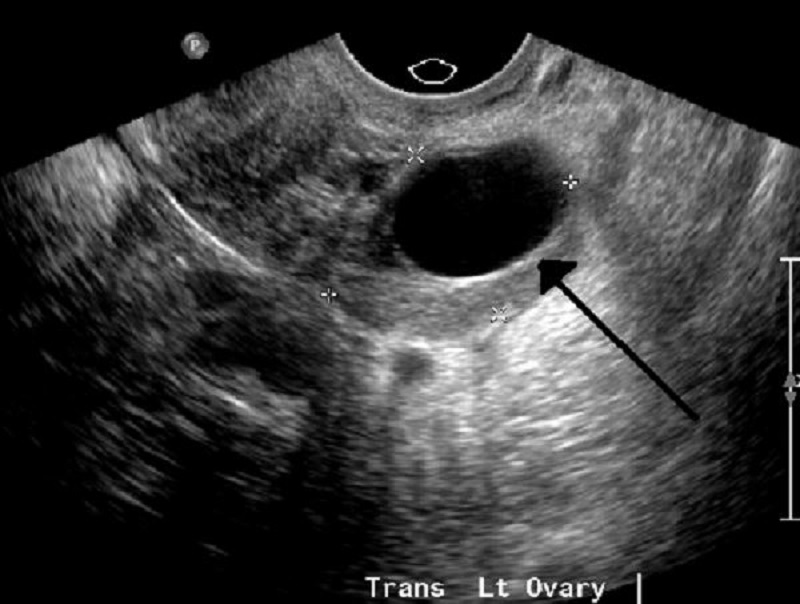 Hình ảnh siêu âm phát hiện sự tồn tại của u nang buồng trứng