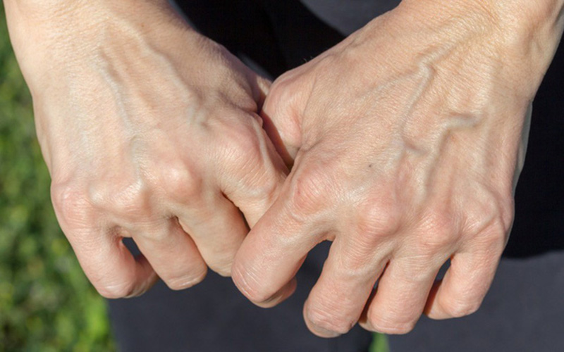 Bàn tay nổi gân xanh có thể là dấu hiệu vấn đề sức khỏe của tĩnh mạch