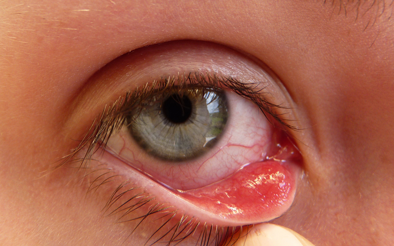 Bệnh đau mắt hột là bệnh thường bị ở góc mí mắt trên hoặc mí mắt dưới
