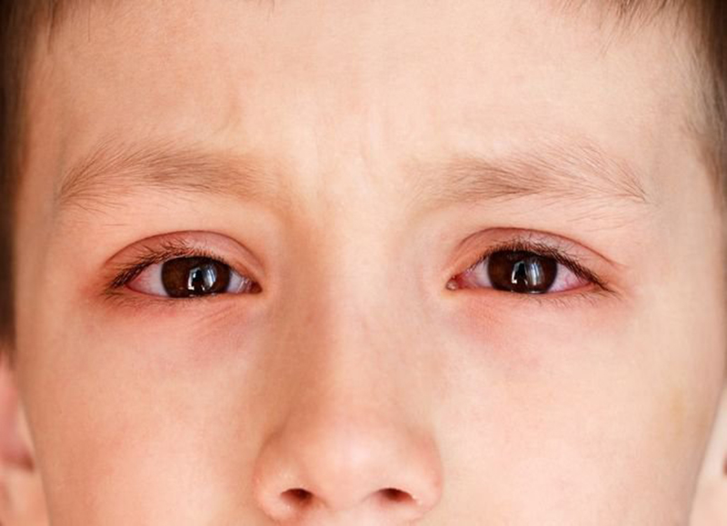 Trẻ em là đối tượng dễ bị lây nhiễm bệnh đau mắt hột nhất