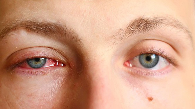 Triệu chứng đau mắt hột thường gặp - sưng mí mắt