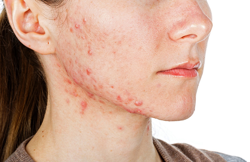 dị ứng da mặt thường gây mẩn đỏ, ngứa rát khó chịu