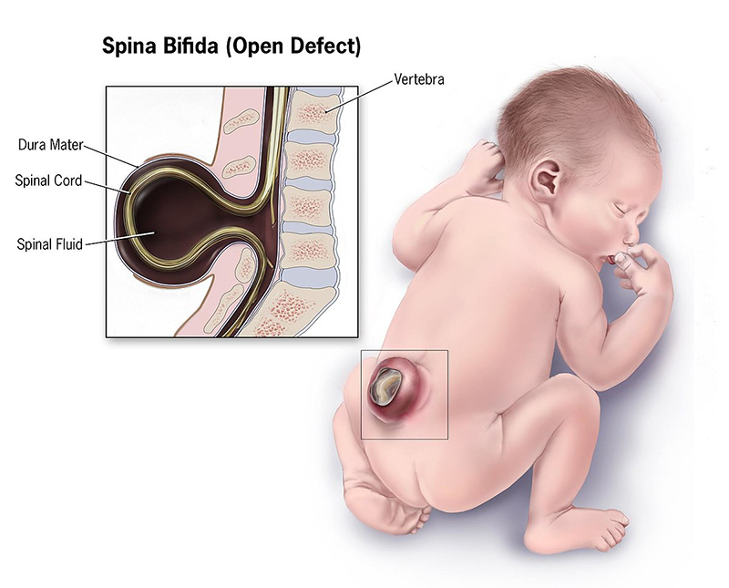 Gai đôi cột sống ở trẻ là tình trạng khuyết tật bẩm sinh xuất phát từ sự phát triển không đúng của ống thần kinh 