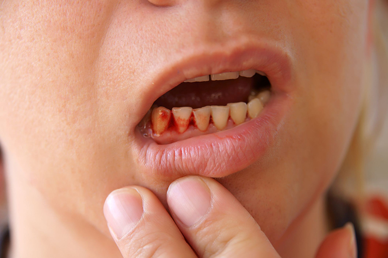 Chảy máu ở chân răng đôi khi là dấu hiệu của một số bệnh lý trong cơ thể 