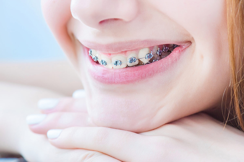 Vào độ tuổi niềng răng “vàng” răng sẽ có tốc độ cải thiện hiệu quả nhất 