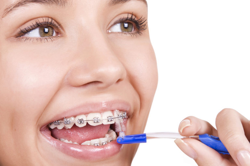 Luôn quan tâm và chăm sóc răng kỹ càng trong quá trình đeo niềng