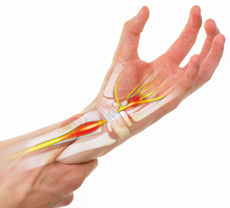 Hội chứng cổ tay là tình trạng bệnh lý xuất phát ở các dây thần kinh ngoại biên