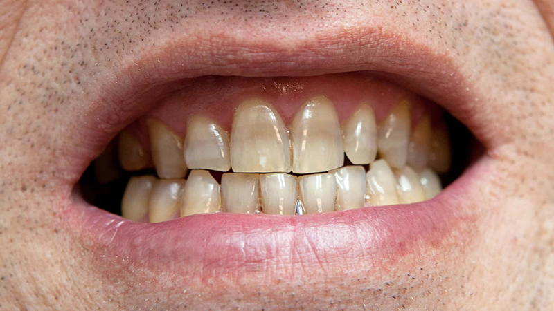 Răng ố màu gây mất thẩm mỹ lựa chọn tẩy trắng răng là giải pháp hợp lý