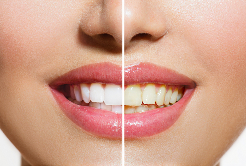 Sau khi tẩy trắng, răng sẽ trắng lên vài tone so với ban đầu