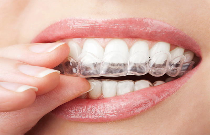 Sử dụng máng để tẩy trắng răng tại nhà tốn nhiều thời gian hơn nhưng giảm độ ê buốt