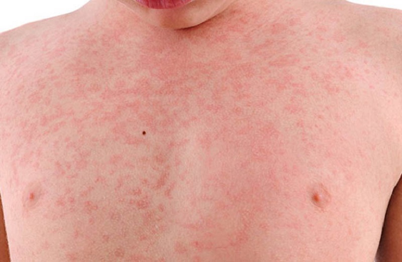 Ban do sốt phát ban dễ dàng biến mất khi kéo căng da