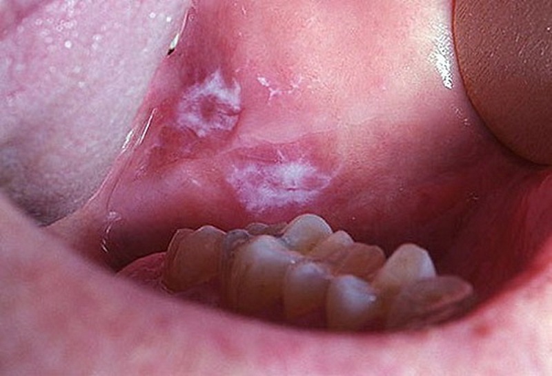 Sự tồn tại của vết loét lâu ngày trong khoang miệng mà không có dấu hiệu khỏi là tín hiệu cảnh báo ung thư khoang miệng