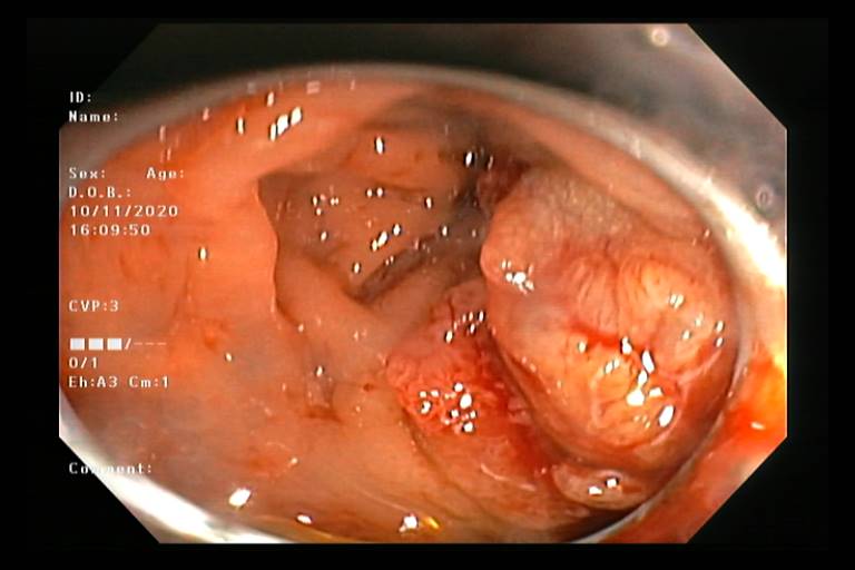 Hình ảnh Polyp và khối u trực tràng của bệnh nhân Đ trong quá trình nội soi.