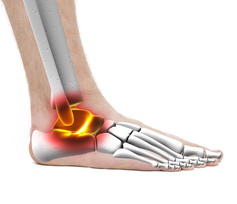 Hội chứng đường hầm cổ chân là tình trạng bệnh lý hiếm gặp xảy ra do chèn ép dưới một lực tác động liên tục