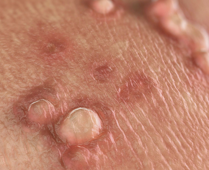 Các khối u nhỏ nhô lên khỏi bề mặt da do sự tấn công của virus HPV ở đường sinh dục