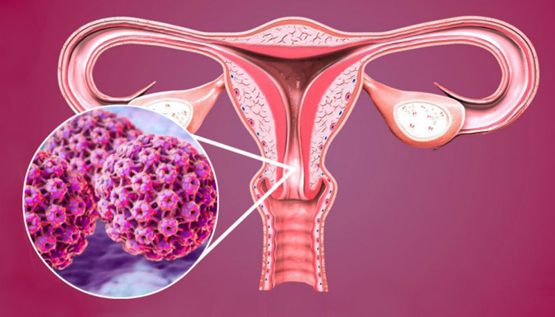 Chủng HPV 16 và 18 là nguyên nhân hàng đầu gây ra các trường hợp ung thư cổ tử cung