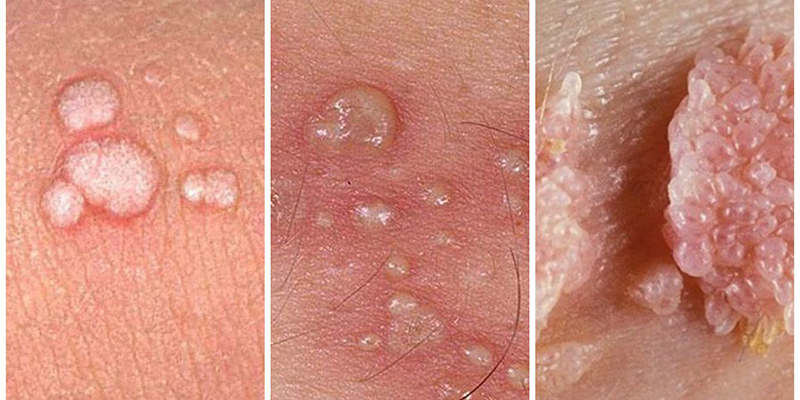 Da của người bệnh nhiễm HPV nổi các mụn cóc sinh dục