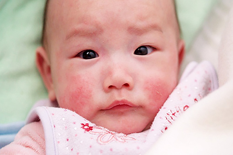 viêm da cơ địa ở trẻ sơ sinh gây tổn thương cho làn da của bé