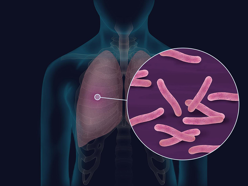 Lao màng phổi là căn bệnh phổ biến do trực khuẩn Mycobacterium Tuberculosis gây ra