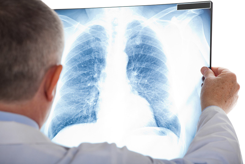 Lao màng phổi có thể phát hiện thông qua chụp phim hoặc các chẩn đoán cận lâm sàng khác