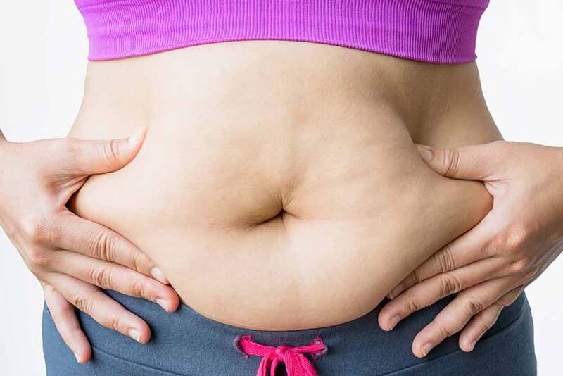 béo phì là gì là tình trạng mỡ tích tụ dư thừa quá mức trong cơ thể