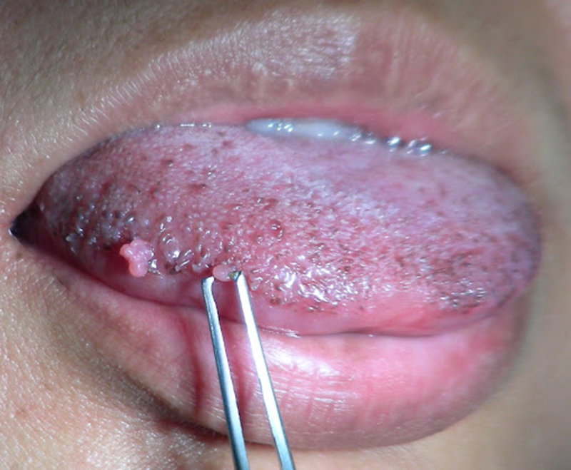 Virus HPV còn có thể dẫn đến tình trạng sùi mào gà ở miệng