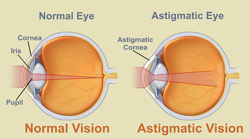 Minh họa sự khác nhau giữa mắt thường và mắt loạn thị