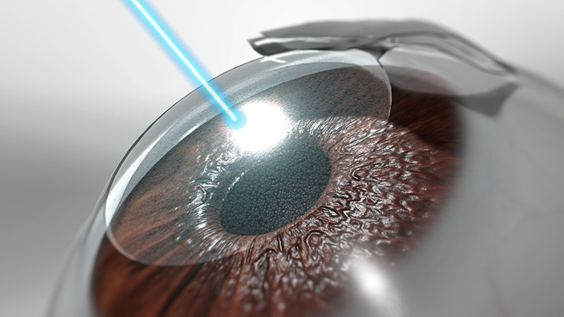 Hình ảnh minh họa phẫu thuật mắt bằng phương pháp LASIK