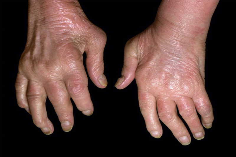 Ngón tay bị biến dạng do biến chứng viêm khớp tiêu xương của bệnh