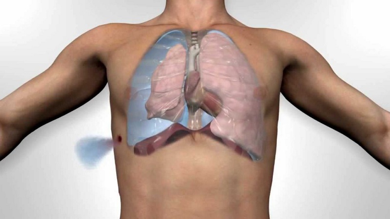 tràn khí màng phổi nếu không điều trị kịp thời sẽ gây ra biến chứng nguy hiểm