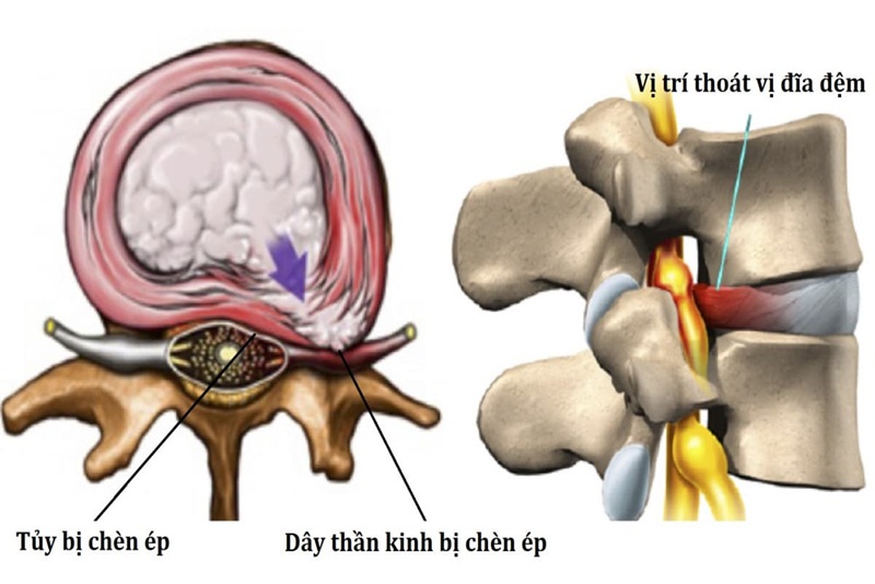 Thoát vị đĩa đệm dẫn đến đau dây thần kinh tọa