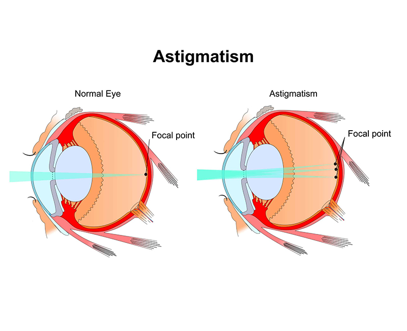 Đeo kính áp tròng cho khả năng sửa hai giác mạc để cải thiện tầm nhìn của mắt