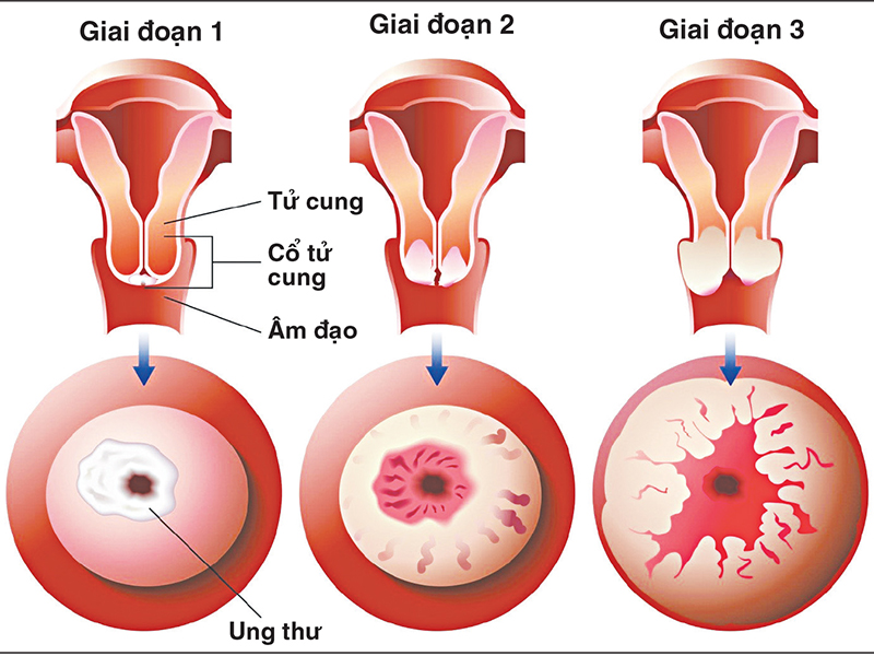 Các giai đoạn phát triển của ung thư cổ tử cung