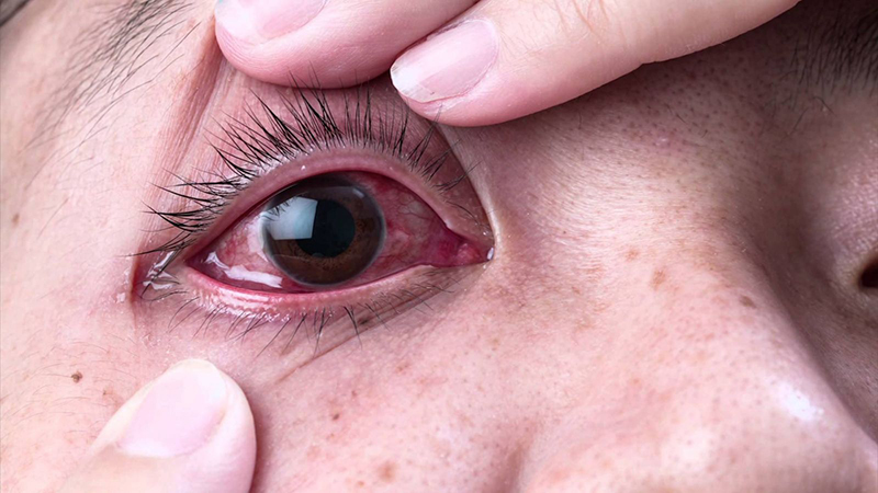 Mắt bị viêm kết mạc do dị ứng thường bị xốn mắt và chảy nhiều nước mắt
