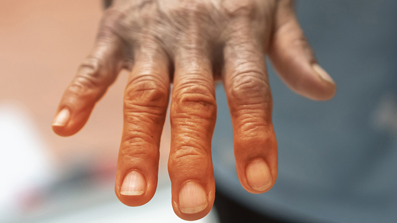 Đau nhức hay tê bì chân, tay có thể xảy ra với nhiều bệnh nhân Lupus