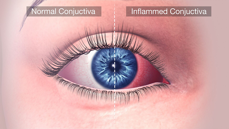 Sự khác nhau giữa mắt thường (bên trái) và mắt viêm kết mạc (bên phải)